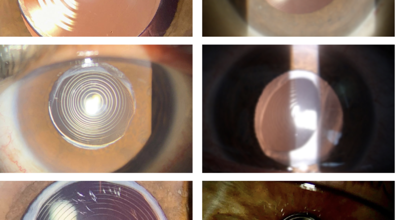 Ojos con diferentes tipos de padecimientos trifocales